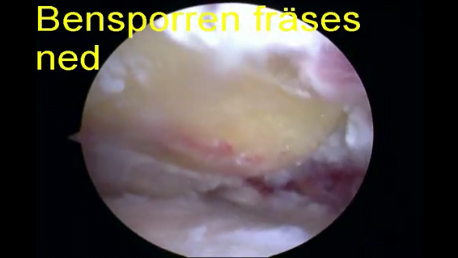 Operation av inklämd sena